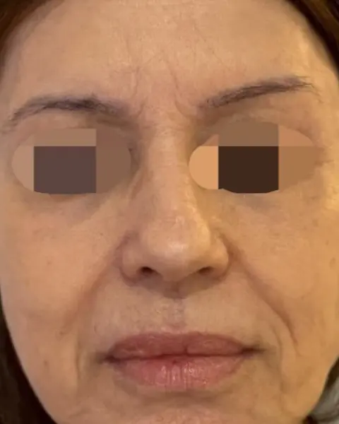 Antes: rosto de frente, com flacidez no contorno