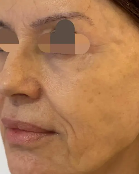 Antes: rosto de perfil, com a mandíbula menos marcada