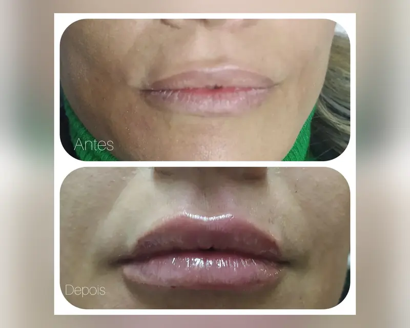 Antes e depois de um preenchimento labial feito pela Dra. Gabriela