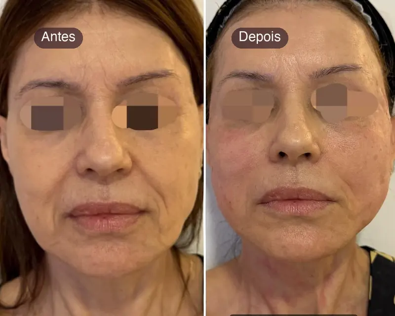 Antes e depois de um lifting com fios de tração, de frente